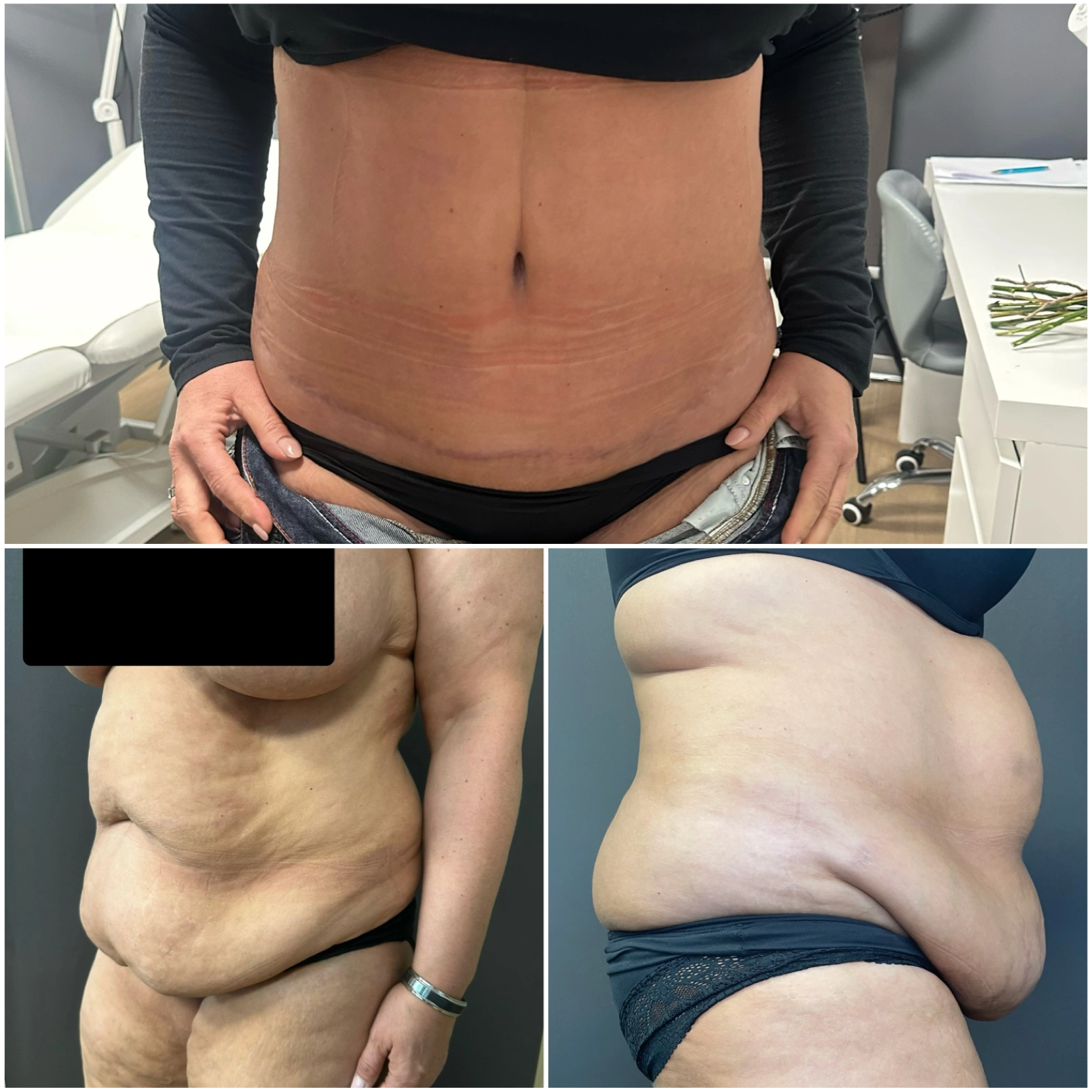 Abdominoplastika s liposukcí — před a po