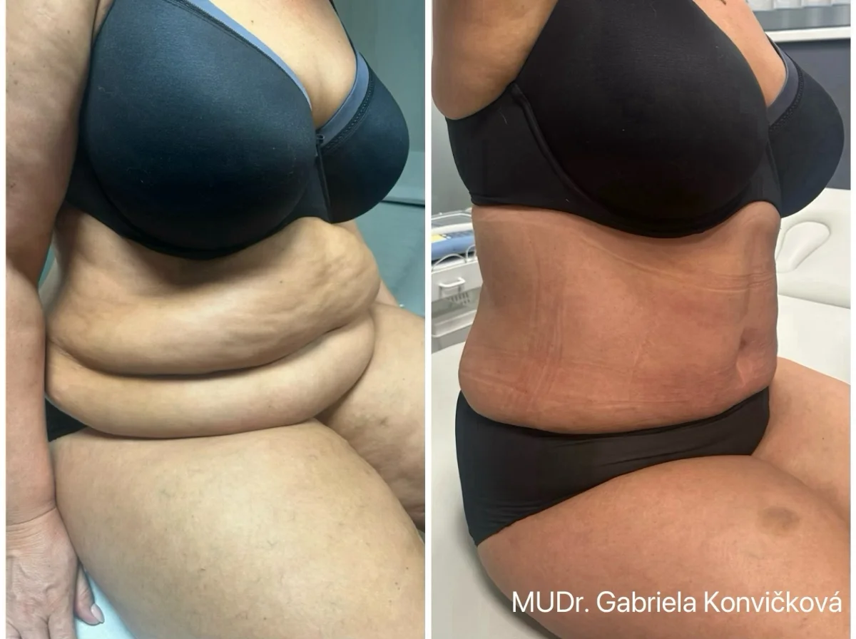 Abdominoplastika s liposukcí — před a po