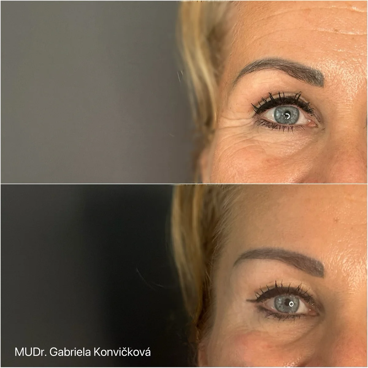 Botulotoxin — browlift — před a po