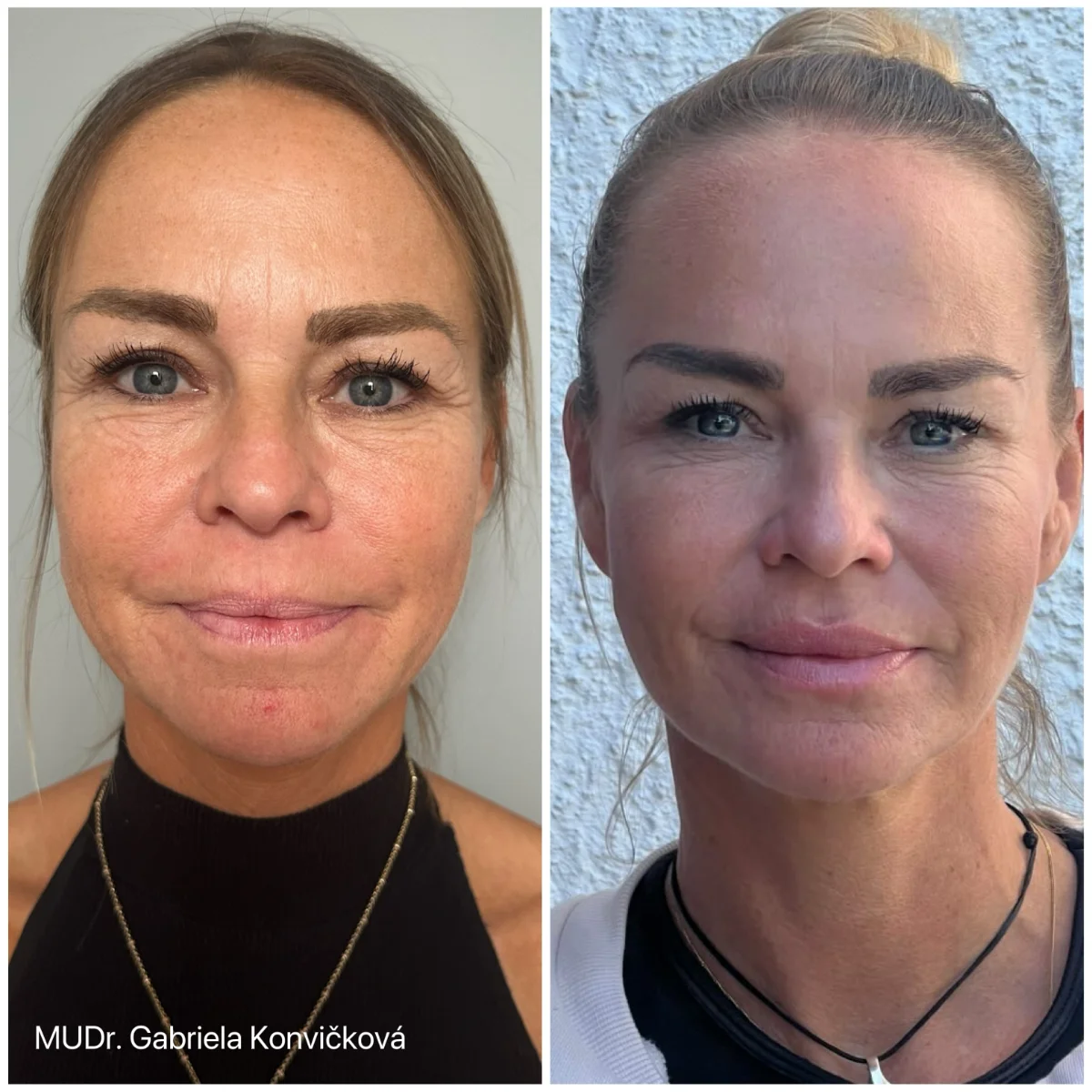 Botulotoxin a výplň — před a po