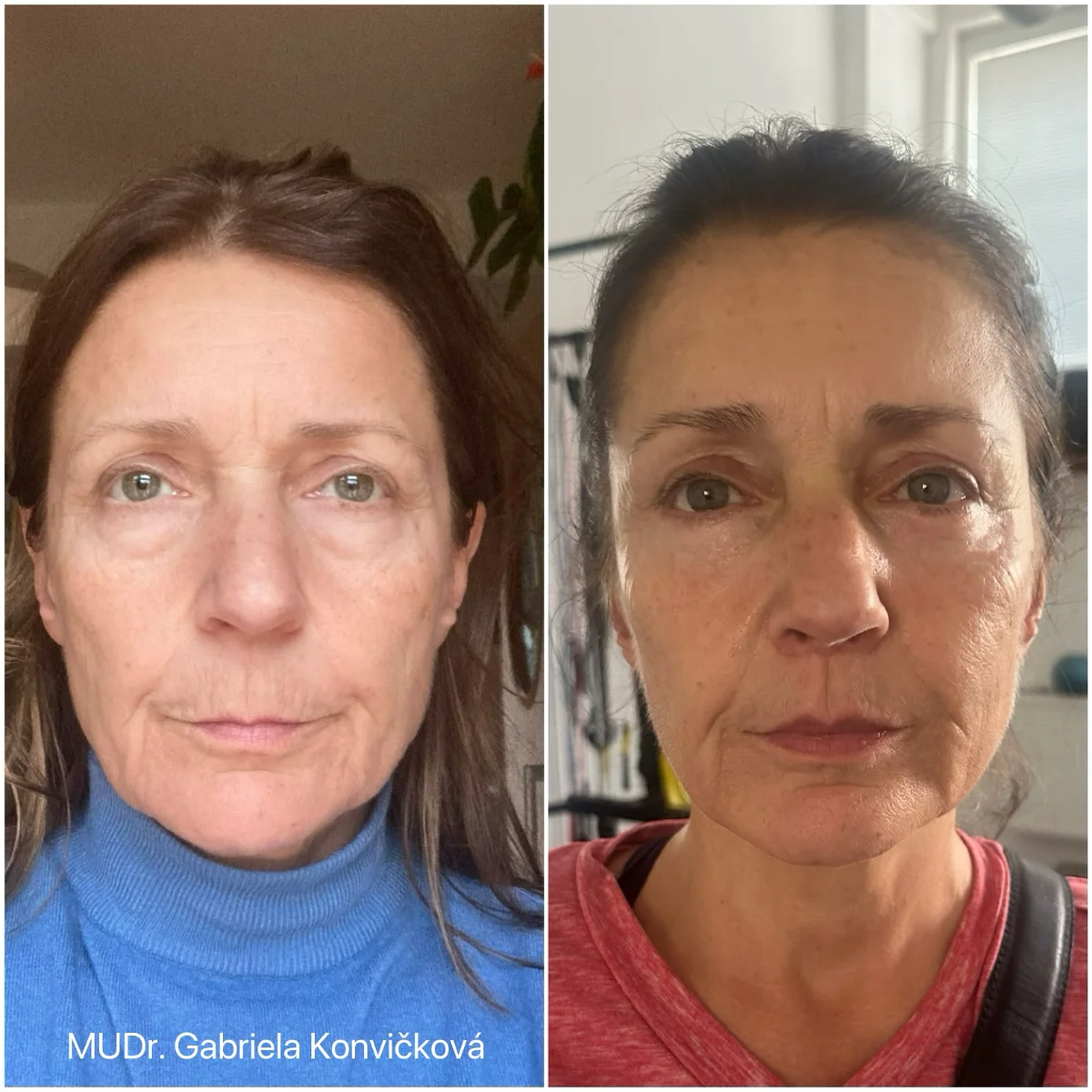 Dolní víčka + lip lift — před a po