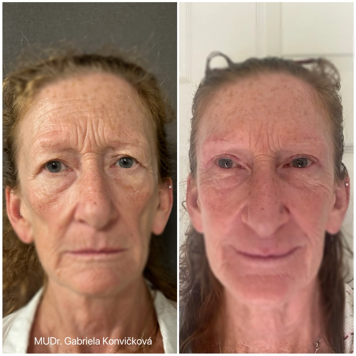 Horní víčka + browlift — před a po