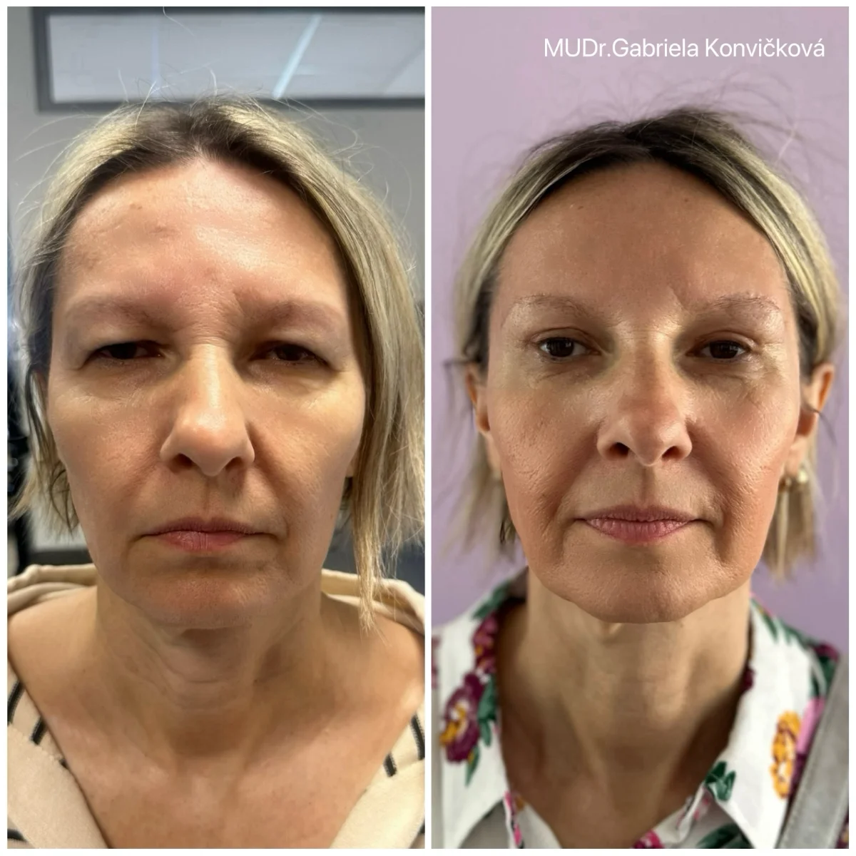 Horní víčka + browlift — před a po