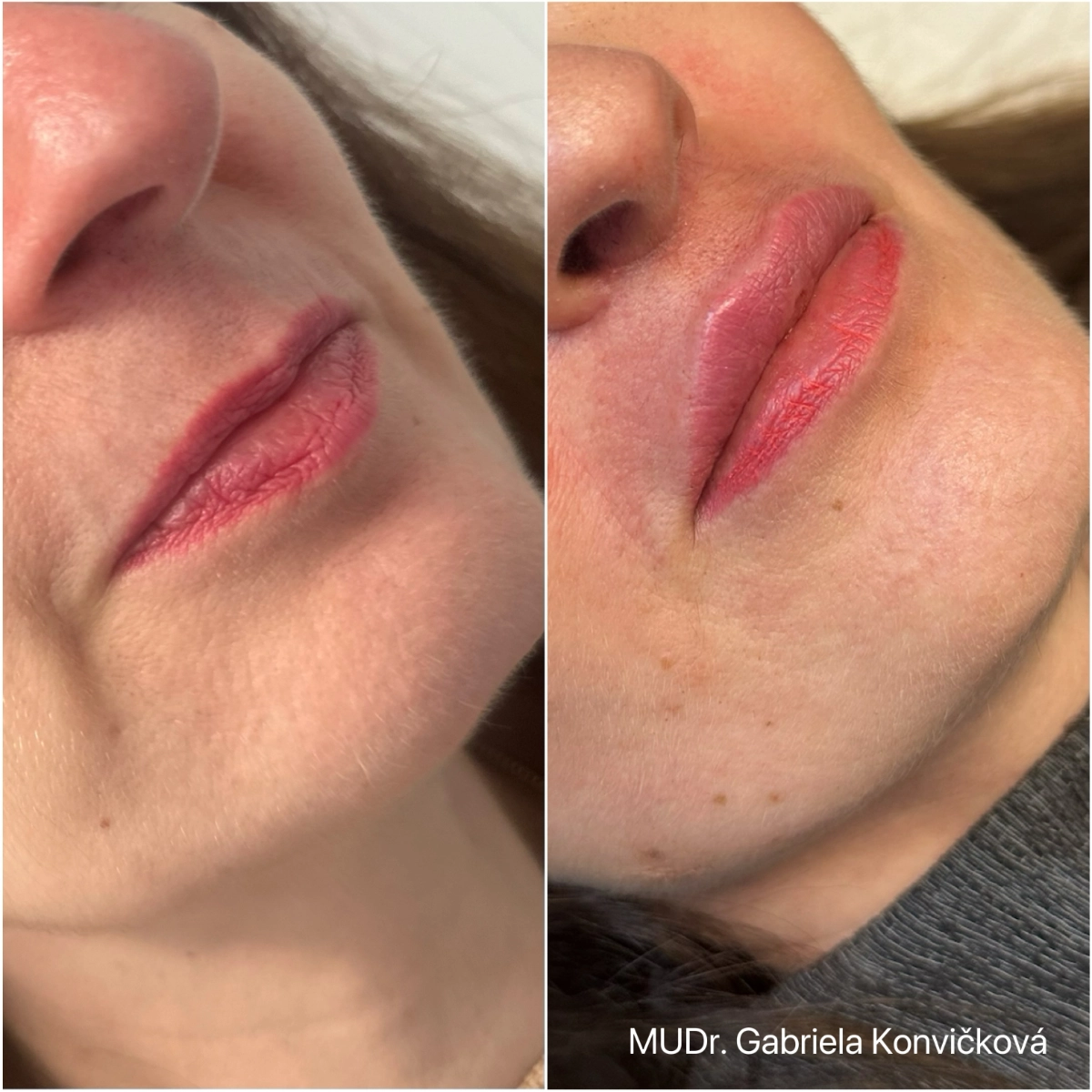 Lip lift + kyselina hyaluronová — před a po