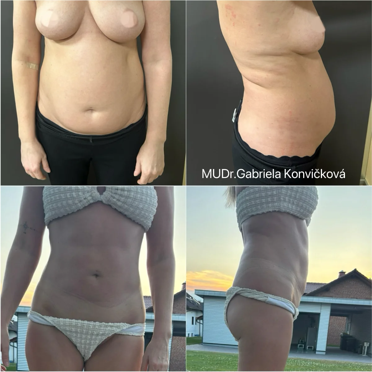 Liposukce břicha a boků — před a po