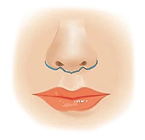 Ilustrace k zákroku